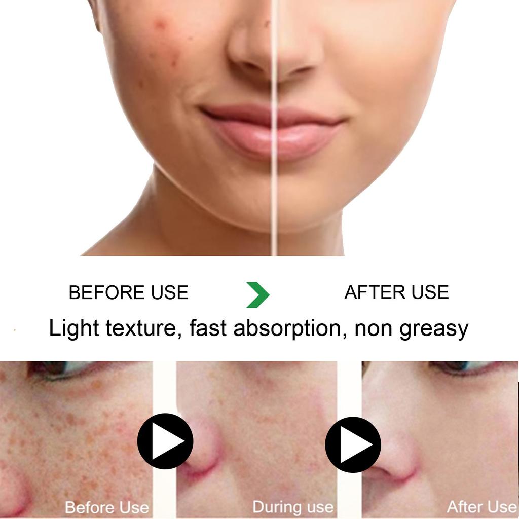 Acne and Spot Removing Cream Lightens Spots Brightens Skin Tone Moisturizes Skin Acne and Spots Skin Care and Repair Cream