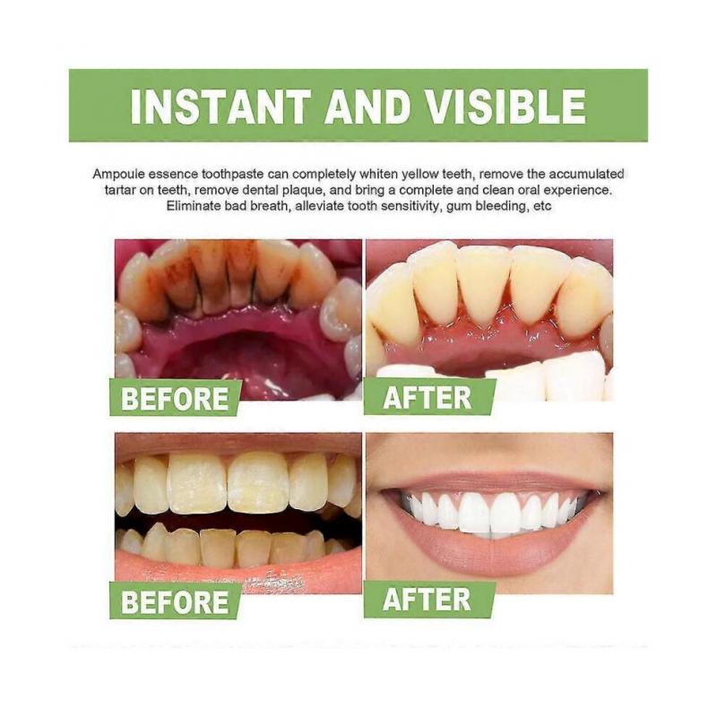 Ampoule Toothpaste,ampoule Tooth Serum, Ampoule Essence Toothpaste,fruit Acid Teeth Whitening Essence (1box/10pcs)