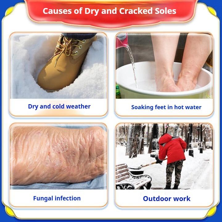 Cracked Feet Cream, Cracked Heels, Cracked Cracks, Fungal Infections, Special Cream for Frostbite Cracks In Hands and Feet