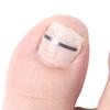1Pcs Toenail Straightening Clip Ingrown Toenail Correction Tool Nail Treatment Elastic Patch Sticker Foot Care Pedicure