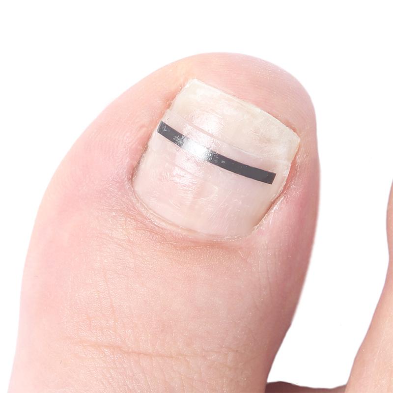 1Pcs Toenail Straightening Clip Ingrown Toenail Correction Tool Nail Treatment Elastic Patch Sticker Foot Care Pedicure