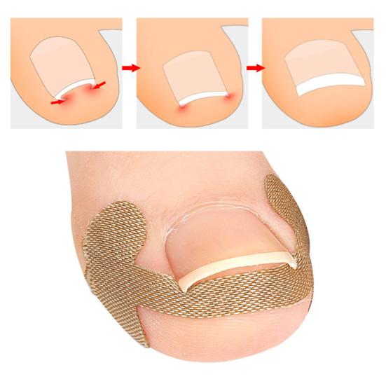 1 Set Nageleinsteller Pediküre-Werkzeug Premium Professional Eingewachsene Zehennägel Fußkorrekturaufkleber Eingewachsene Zehennägel Korrektur