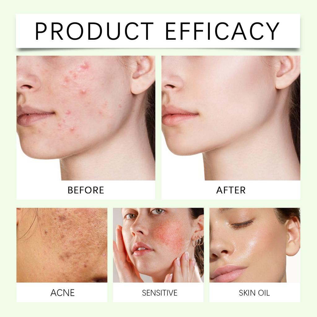 Ampoule For Sensitive Skin With Centella Asiatica Help Reduce Redness And Breakouts. Low-irritating, Moisturizing & Soothing Serum(30ml