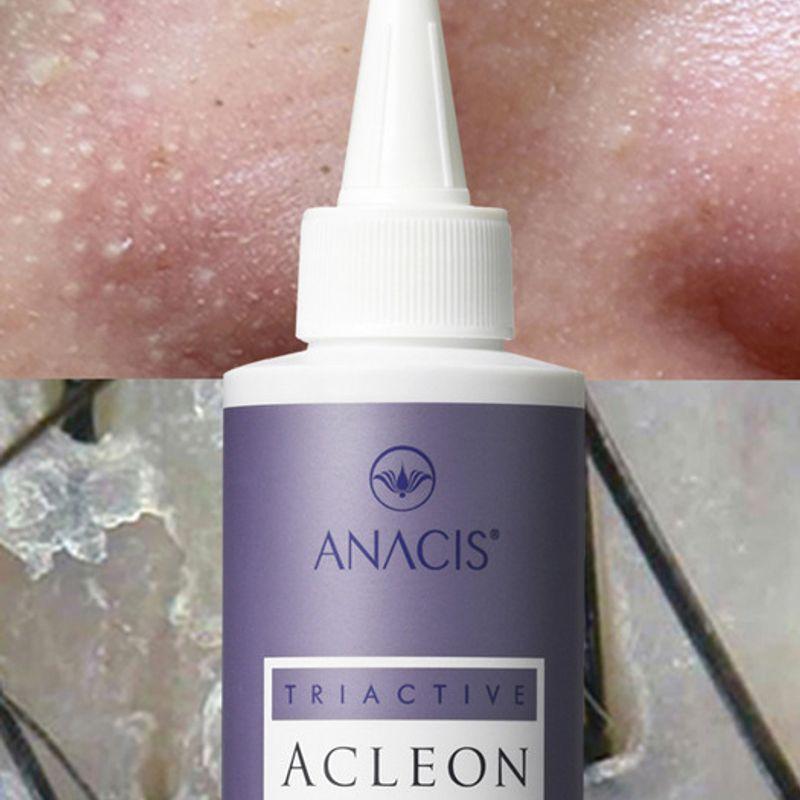 Acleon Sebum Removal Seboex 200ml (15ml Pore Ampoule Included)
