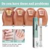 Pen Nail Care Nail Fungus Austrian Experiences Treatment Quick Intensive Remover