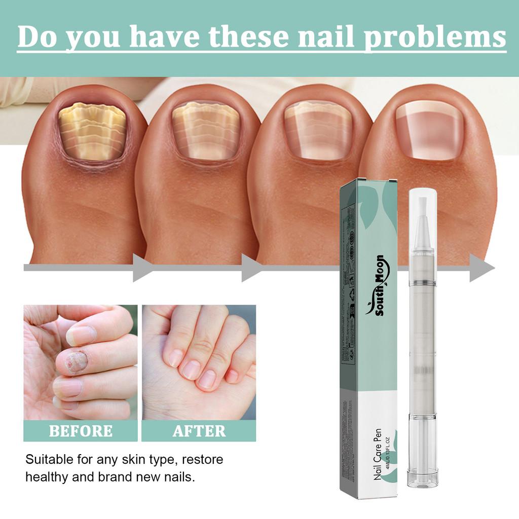 Pen Nail Care Nail Fungus Austrian Experiences Treatment Quick Intensive Remover