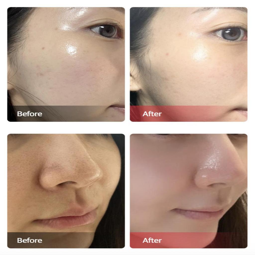 [BIO NEEDLE] Microneedling Nano Shot Auto MTS Device Home Care Beauty Device Skin Pore Care