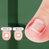 10Pcs Toenail Straightening Clippers Toenail Correction Tools Set Nail Care Elastic Stickers Pedicure Foot Care Tools