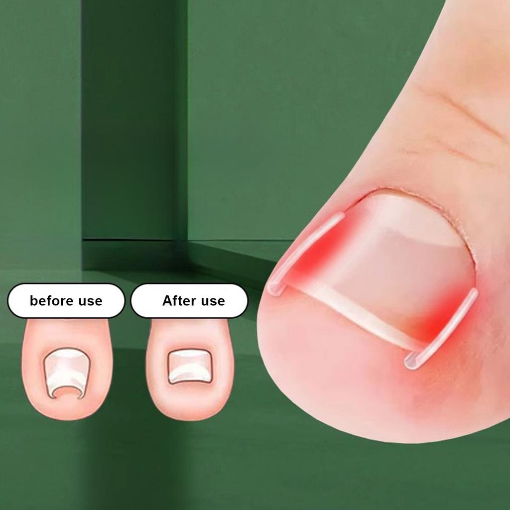 10Pcs Toenail Straightening Clippers Toenail Correction Tools Set Nail Care Elastic Stickers Pedicure Foot Care Tools