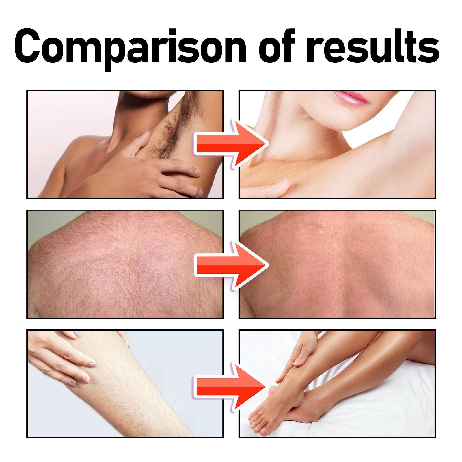 Бережное удаление волос из подмышек и губ по всему телу — фото 7