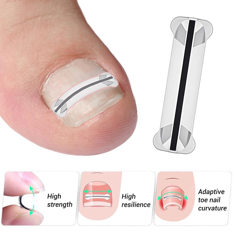 1Pcs Nail Correction Stickers Ingrown Toenail Corrector Patches Invisible High Strength Auxiliary Patch Paronychia Treatment