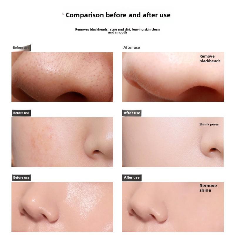 Jinniya Blackhead Removal Nose Mask - Unclogs Pores & Cleanses Acne for Men & Women