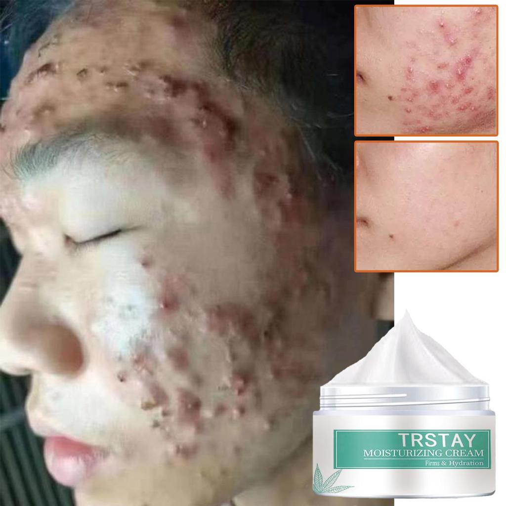 Mild and non irritating, nourishing face cream can tighten skin, moisturize and brighten skin tone, remove acne marks, and make skin soft and delicate