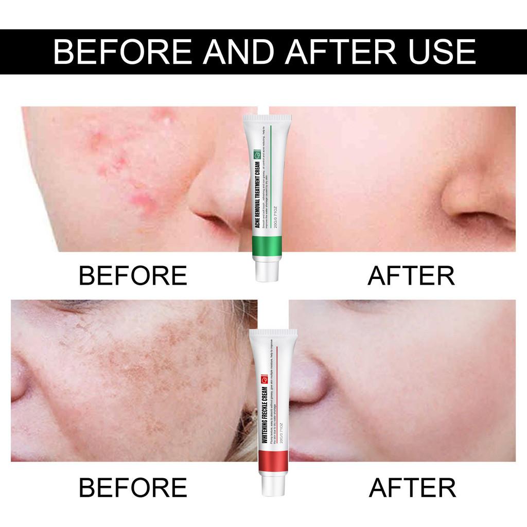 Premium Acne Scar And Spot Cream For Brightening Skin Tone And Moisturizing