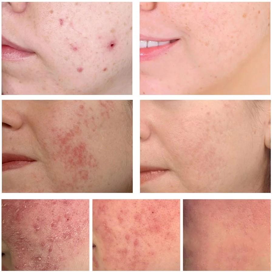 Effektive Creme zur Entfernung von Akne, Behandlung von Aknenarben, Schrumpfung der Poren, Ölkontrolle, Aufhellung, Befeuchtung des Gesichts