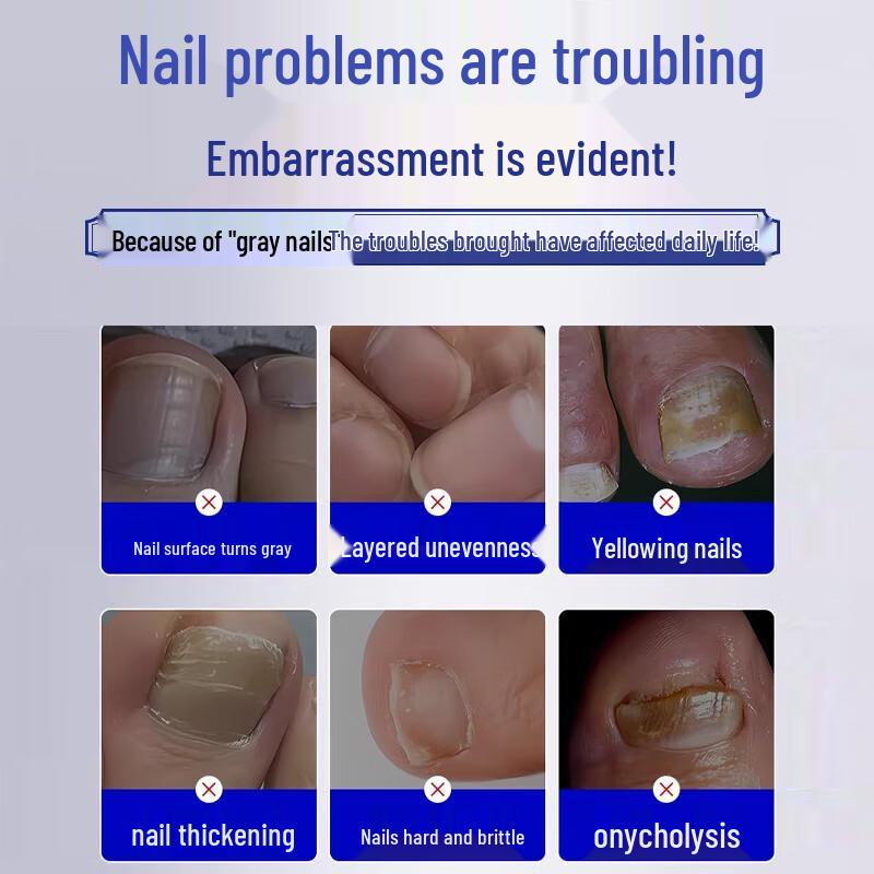 Jingpeitang Onychomycosis Nail Repair Solution
