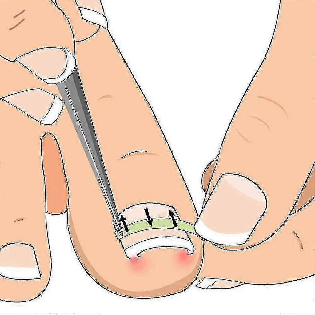 10Pcs Ingrown Toenail Corrector Curved Clip for Paronychia Relief Thick Nails