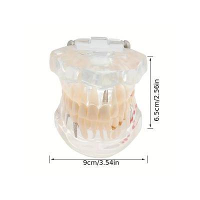 Transparent Disease Teeth Model Dental Implant Teeth Model Dentist Dental Student Learning, Teaching, Research Communication