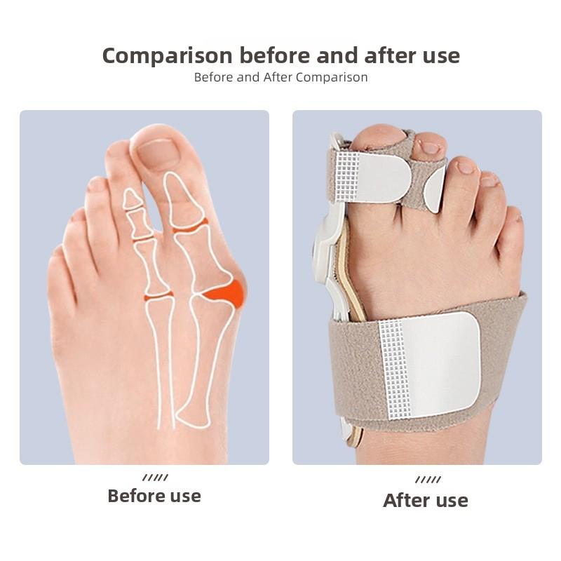 Dag och Natt Tumbvalgus Tåvalgus Storfotsbensträckare Stortåjusterare