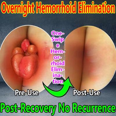 Soothing Pain Relief Cream for Rectal Abscission, Internal Hemorrhoids and External Hemorrhoids Mixed Hemorrhoids