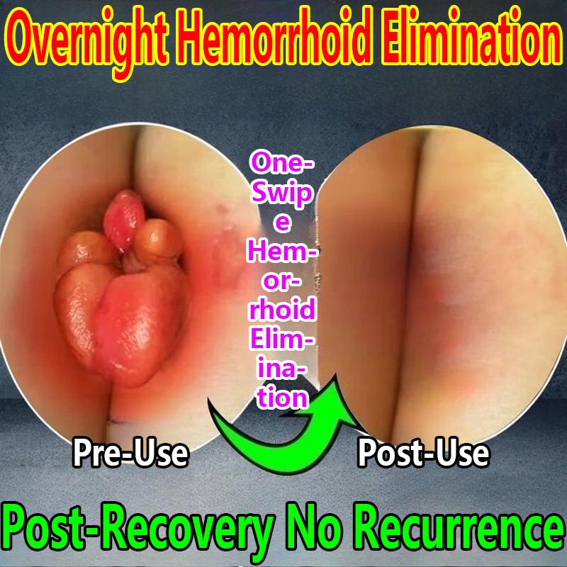 Soothing Pain Relief Cream for Rectal Abscission, Internal Hemorrhoids and External Hemorrhoids Mixed Hemorrhoids