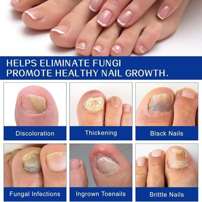 Adesivos Suaves para Unhas Fúngicas Portáteis Eficazes Adesivos para Unhas dos Pés Restauram a Resiliência das Unhas Fácil de Usar Adesivos de Reparo para Unhas
