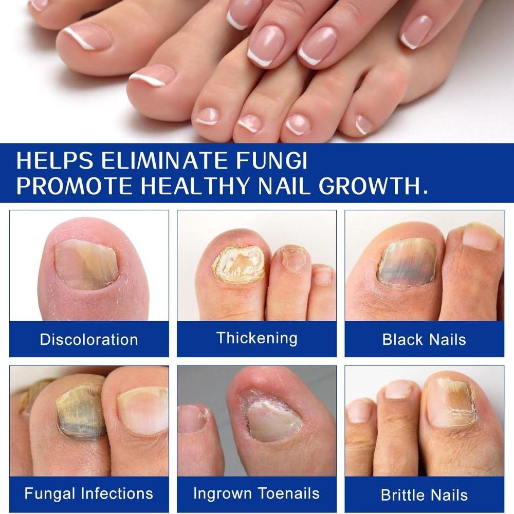 Gentle Fungal Nail Patches Portable Effective Toenail Patches Restore Nails Resilience Easy to Use Nail Repair Patches colore grigio chiaro