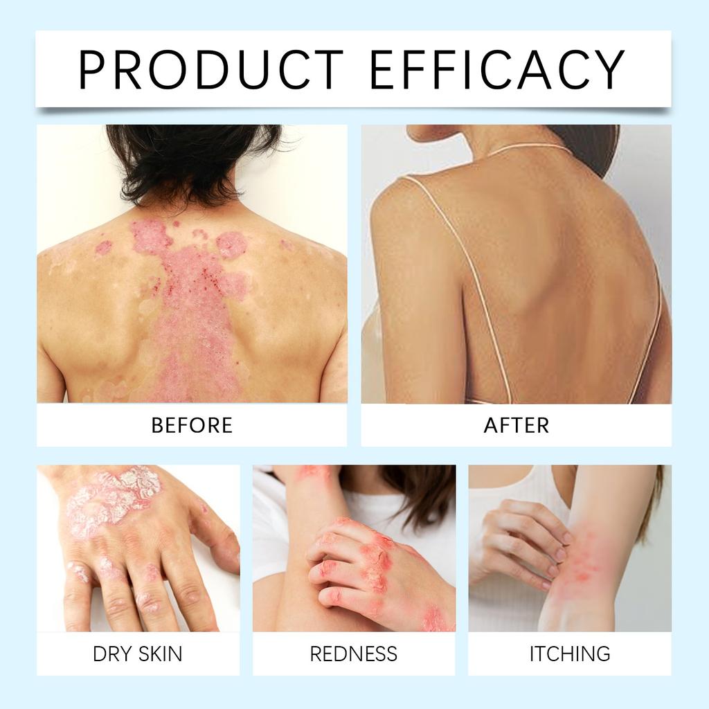 BeeAnti Fungal Cream,Fungus TreatmentCream, Itchy Skin Relief Cream,It Can Skin Ringworm Caused By Fungal .