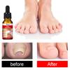 Zehennagelpflege-Serum 10ml Feuchtigkeitsspendendes Nagelöl Fußpflegebehandlung Nährende Nagelpflege-Essenz für den täglichen Gebrauch