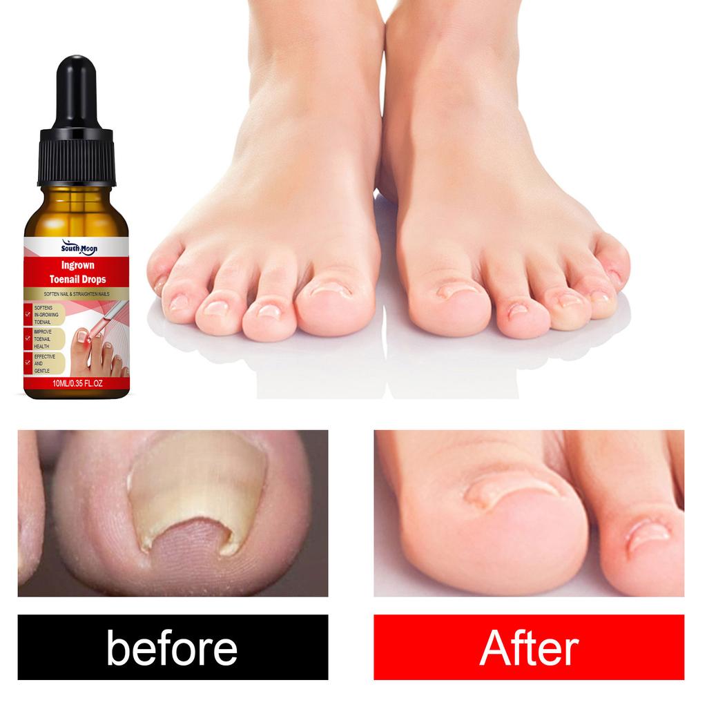 Zehennagelpflege-Serum 10ml Feuchtigkeitsspendendes Nagelöl Fußpflegebehandlung Nährende Nagelpflege-Essenz für den täglichen Gebrauch