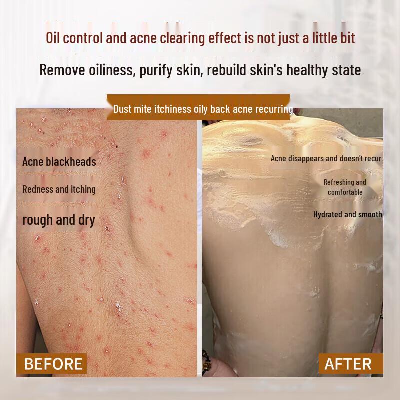 SEEDONVEUR Sulfur Shower Gel for Acne & Oil Control