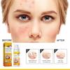 Cystic, Hormonal And Severe Acne Treating Cream Spray For Adolescent And Adult Acne Skin Care 30ml