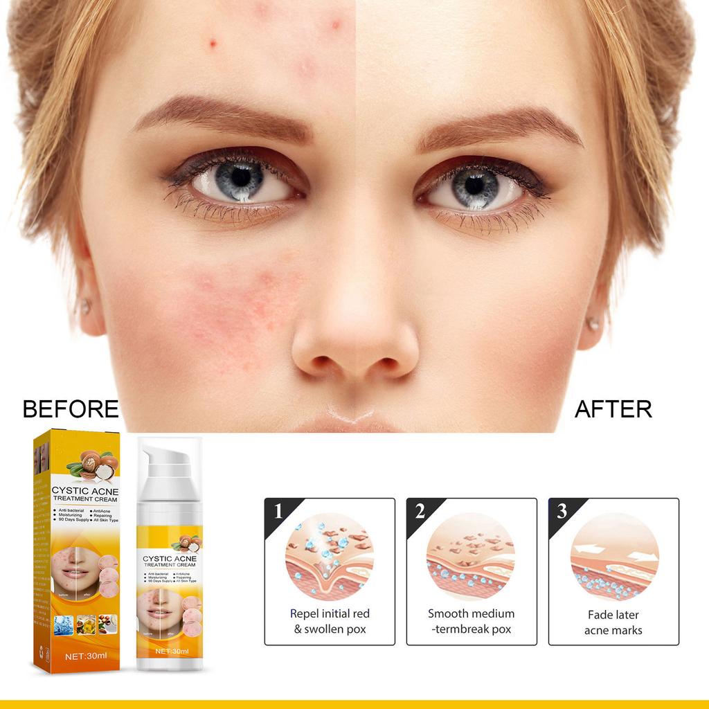 Cystic, Hormonal And Severe Acne Treating Cream Spray For Adolescent And Adult Acne Skin Care 30ml
