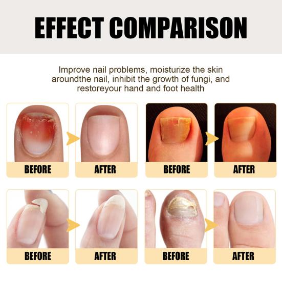 20ML Nail Repair Serum Mild Natural Ingredients Strengthen Nourish Cracked Brittle Nails Intense Nail Strengthening Serum