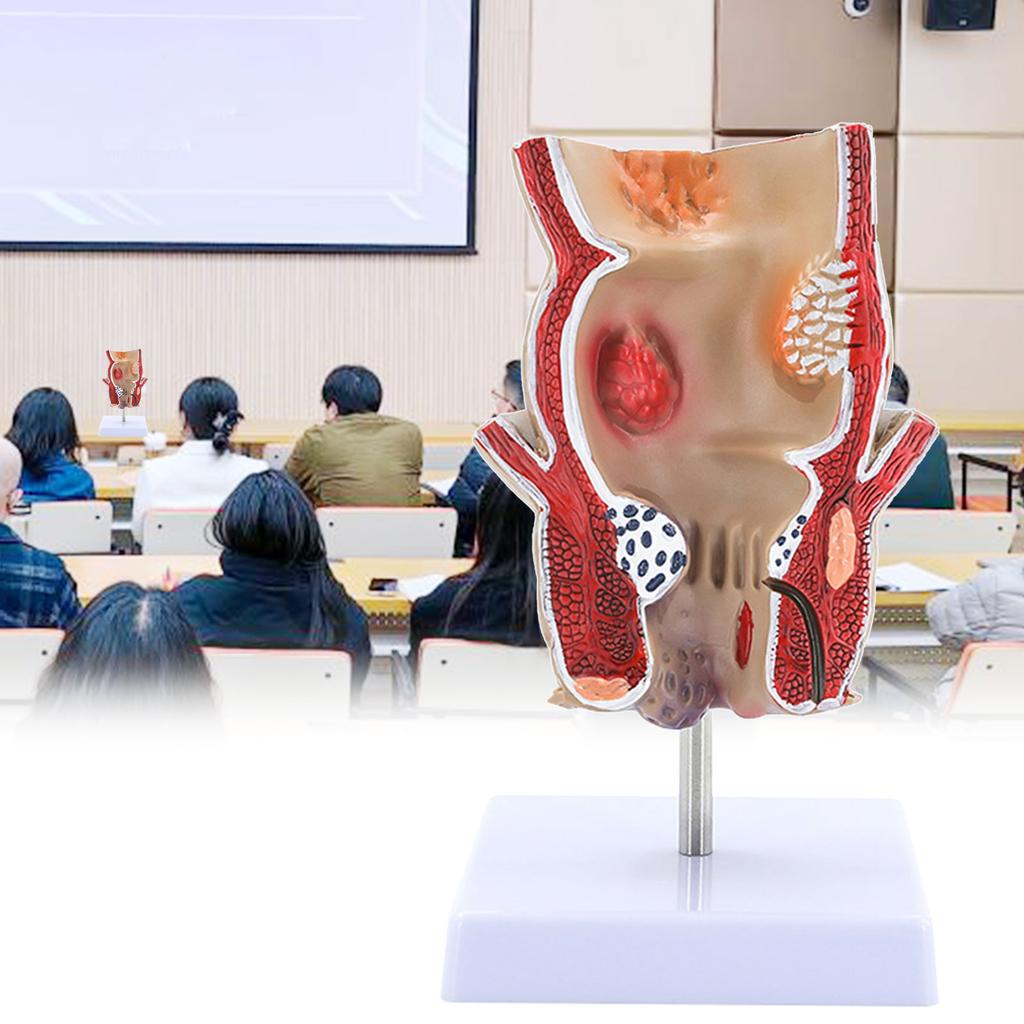 Human Pathologies of Rectum Model Medicals Teaching Tool Human Rectum Model Human Anatomy Model Teaching Supplies