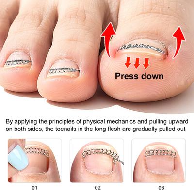 12 Pièces Fixateur de Fil Correcteur d'Ongle Ongle Incarné Redresseur Kit de Correction d'Ongle pour Paronychie Redressement Soin de Pédicure