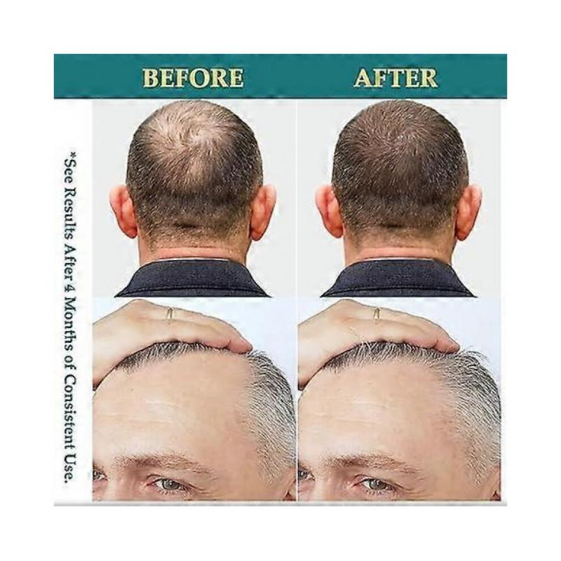 Natural Hair Growth Oil Spray: Batana Rosemary Serum Biotin Caffeine Scalp Care Treatment - Thinning Hair Regrowth Thickening for Women Men