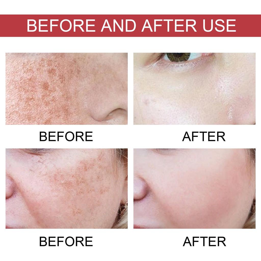 Hoygi Dark Spot Repair Essence: Lightens Dark Spots, Reduces Pigmentation, Age Spots, Moisturizes and Brightens Skin.