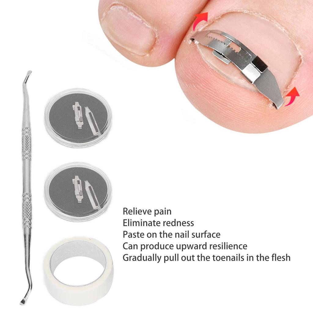 2pcs Ingrown Toenail Corrector Stainless Steel Straightening Pedicure Tool for Paronychia Treatment