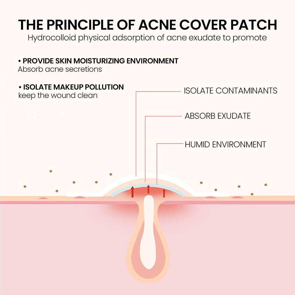Pimple Patches For Face,Zit Covers,Hydrocolloid Acne Patches Zits Cover Stickers 2 Size 36pc
