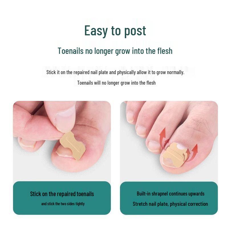 Glue-Free Press-On Toenail Stickers: Lala Nail Repair & Ingrown Correction Patches