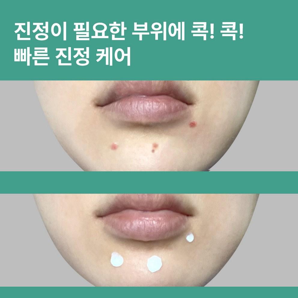 [GreenLog] Zinc Spot Ampoule for Acne & Sebum Control