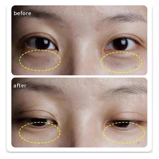 Yousheng 1 Pair Eye Patch Micro Needle Brighten Eyes Tone Recover Elasticity Hyaluronic Acid Anti Wrinkle Eye Patches for Girl