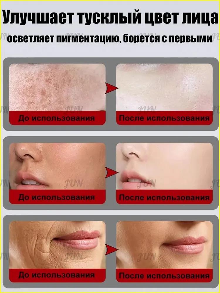 Retiderm anti-aging face cream, Freckle removal and whitening cream is able to remove freckles, chloasma, sunspots, age spots, Contains hyaluroni