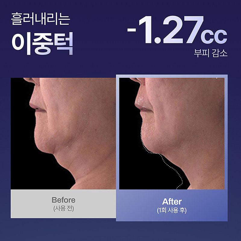 Meditherapy Inmotox Peptide Shot Cream + Suction Jet Device – Korean Hydrating Face Lifting & V-Line Care Set