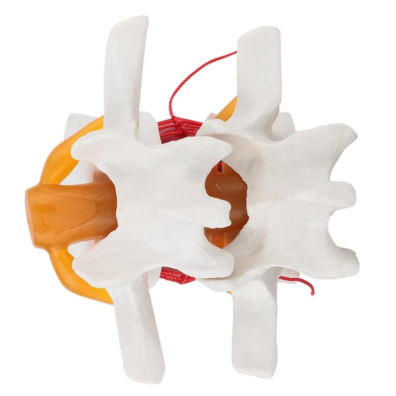 1:1.5 Medical Demonstration Model Of Lumbar Vertebral Spine Human Lumbar Disc Herniation Model