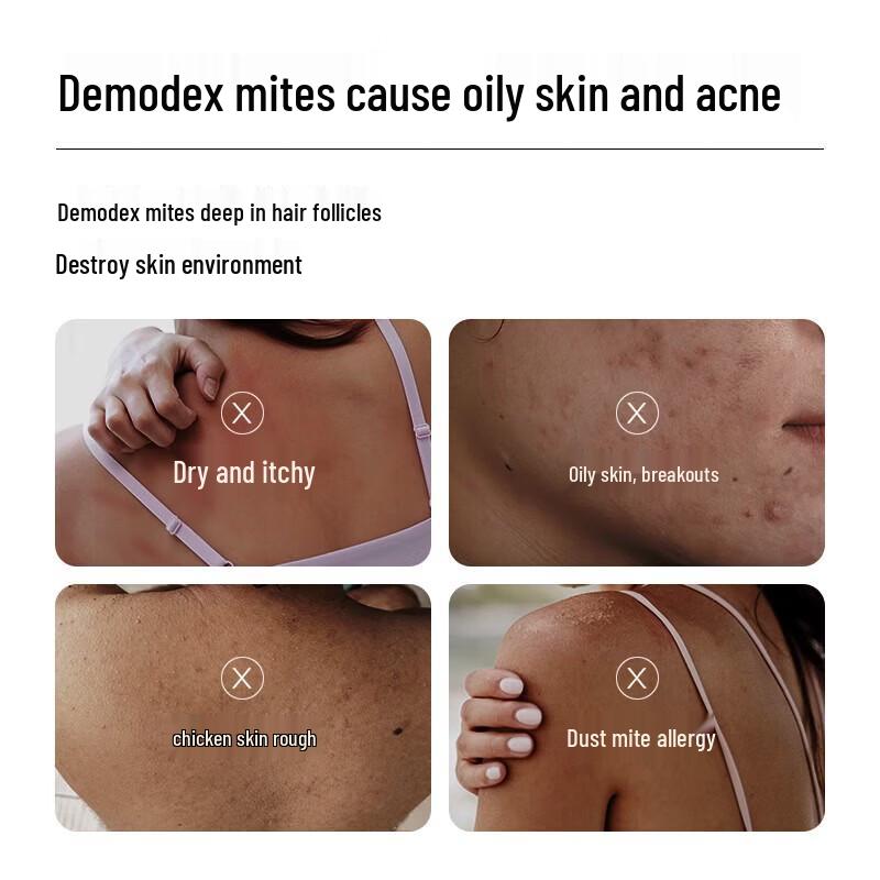 MANTING Demodex Mite Removal Set