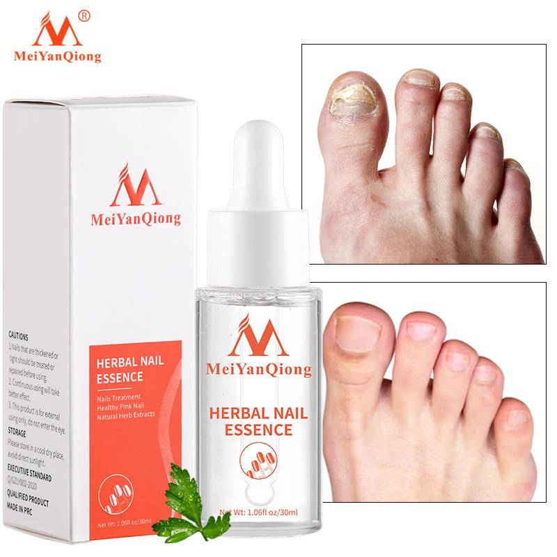 Herbal Nail Treatment Essential Oil Hand and Foot Whitening Toe Nail Removal Feet Care Polish Nail Gel Nail Repair Treatment