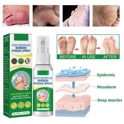 Fußpilzspray, Fußpilzspray, Fußpilz, Füße riechen, Füße jucken, Schwitzen, Schälen, Blasen 30ml