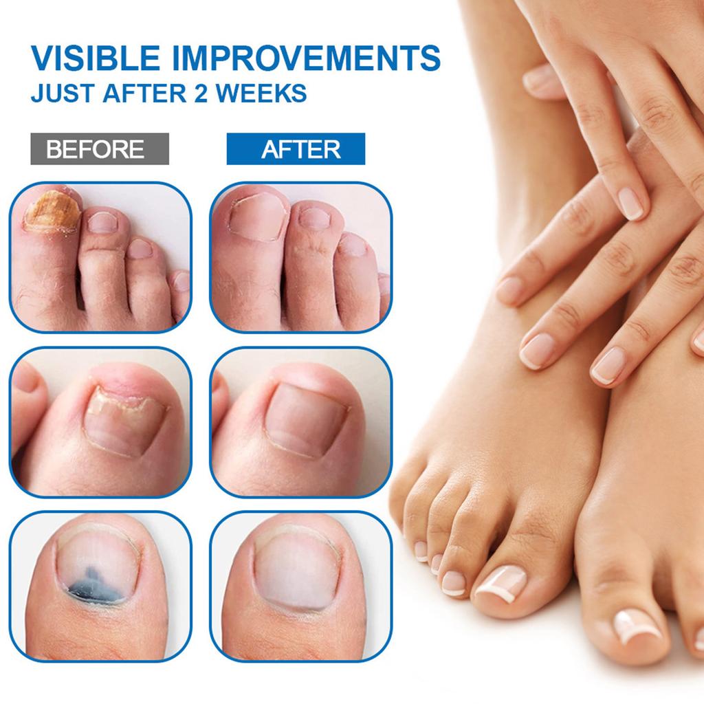 Gips Ny Bright Nail Plaster Lindrer Onychomycosis Og Neglepleie